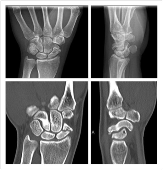 The image displays pre-op X-rays/CTs of scaphoid waist nonunion, with 10mm erosion/bone loss, humpback deformity, and early wrist instability.