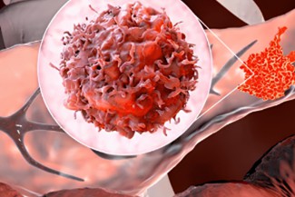 Cancer cell close-up showing irregular surface and tumor spread process.