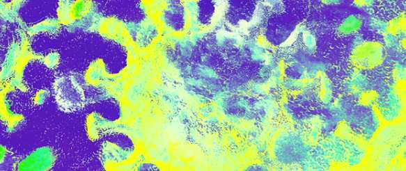 Urine Protein/Creatinine Ratio - Alta DiagnoTech